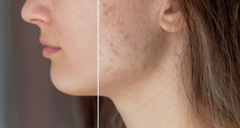 Acne and Acne Scar
