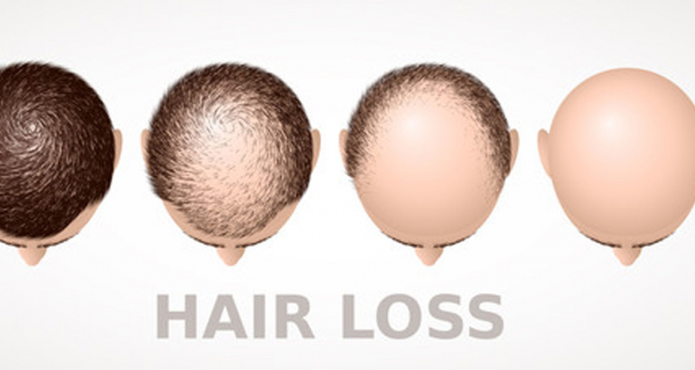 Hair Loss and Alopecia