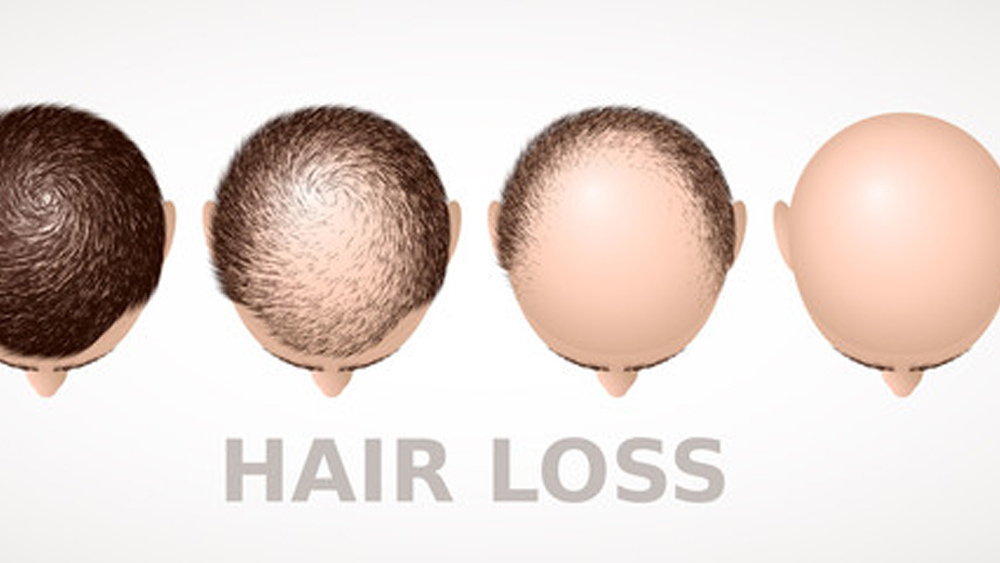 Hair Loss and Alopecia