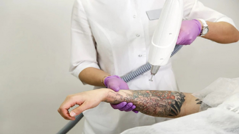 Laser Tattoo Removal – Dr Sanyogita Singh