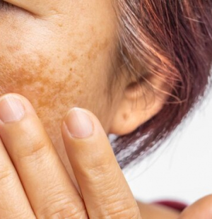 Face Pigmentation