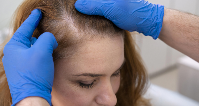 Understanding Alopecia Causes in Females