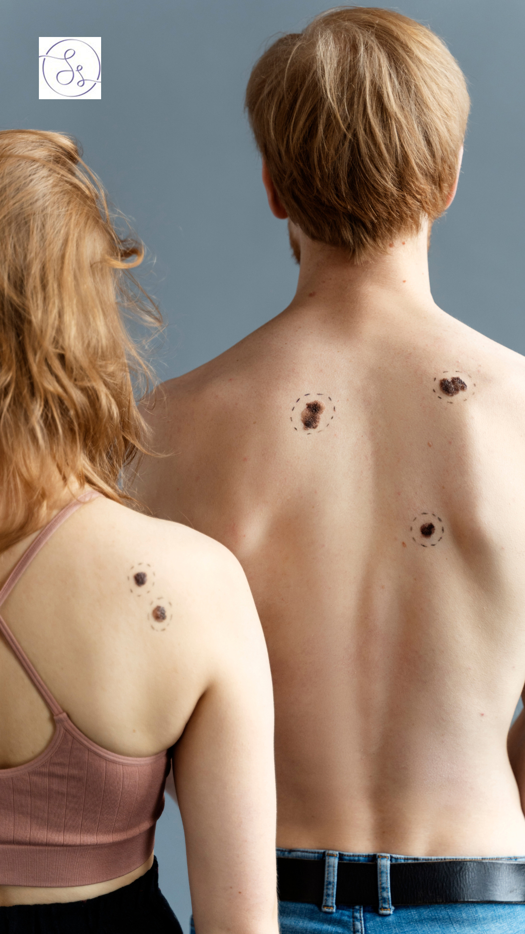 How to Remove Skin Tags Safely, According to Dermatologists