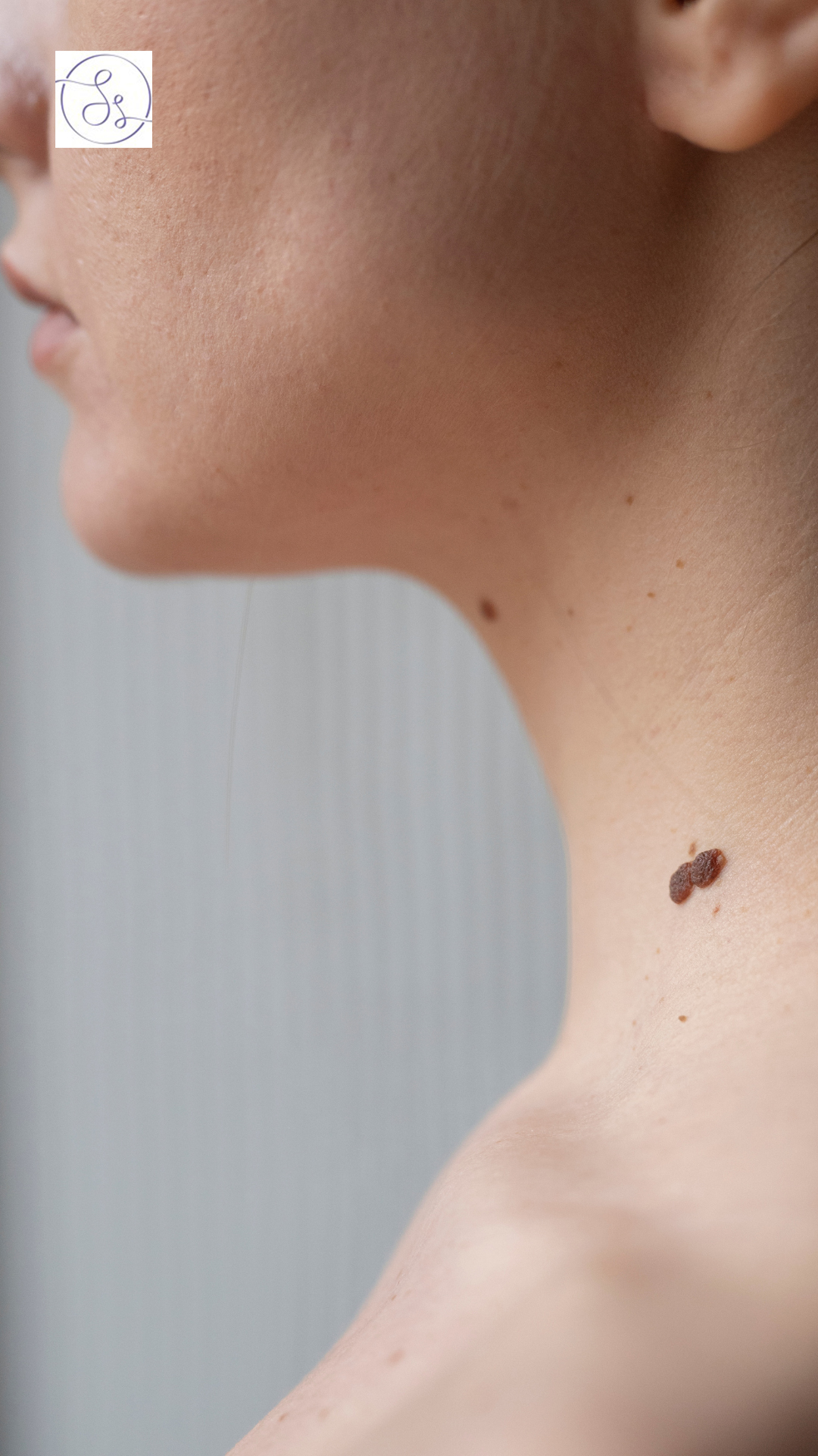 Skin tags, benign skin tumors, are small, soft growths commonly found in adults where skin rubs.