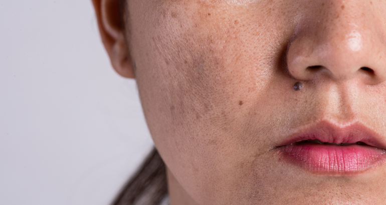 Skin Pigmentation Treatment: Rediscover Your Radiant Skin
