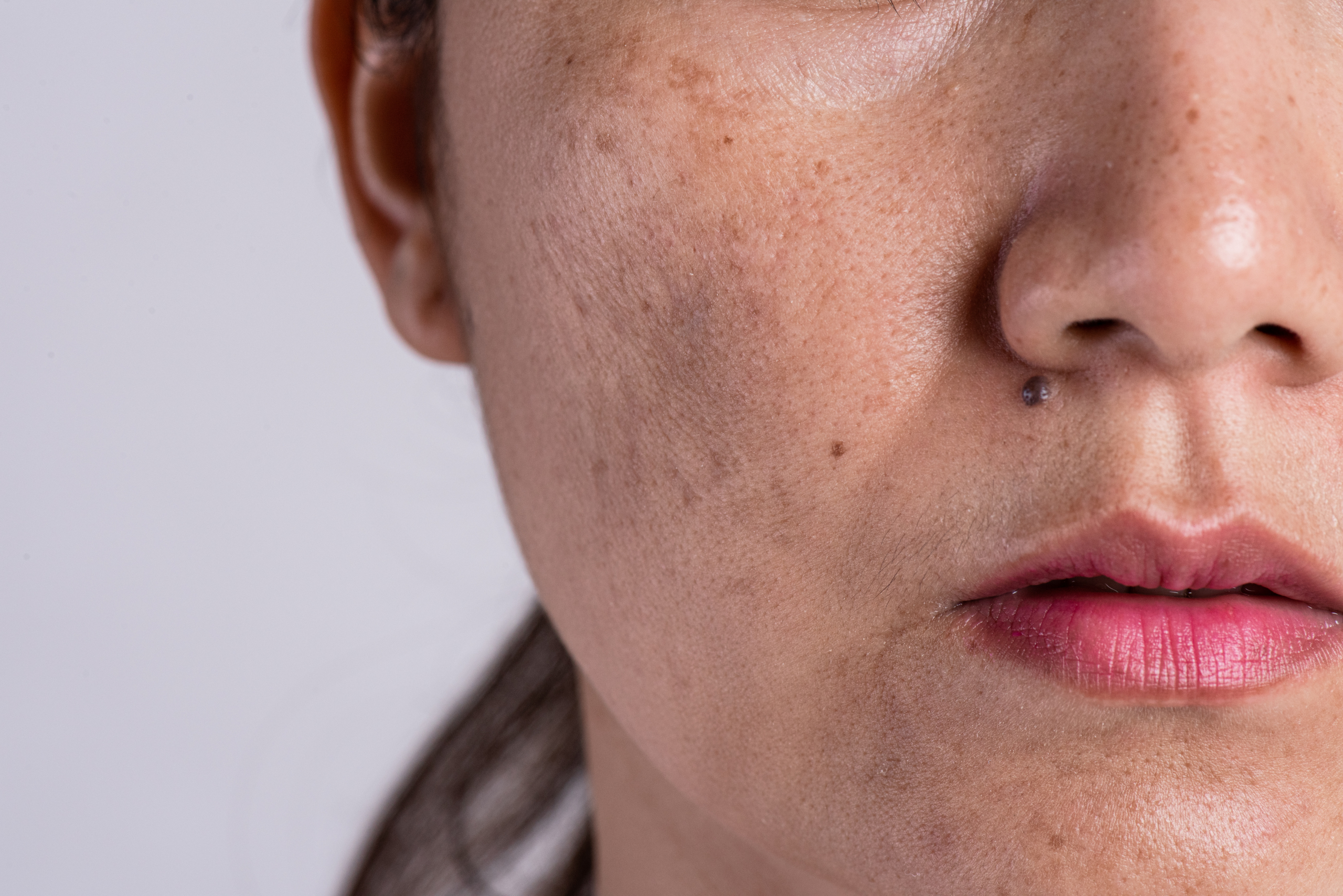 Skin Pigmentation Treatment: Rediscover Your Radiant Skin