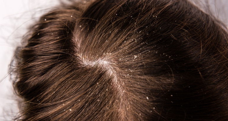 How to avoid extreme dandruff in winters?