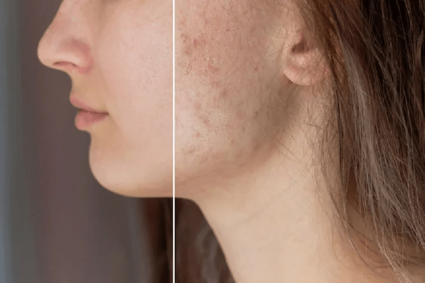 Acne Scar Treatment in Jaipur