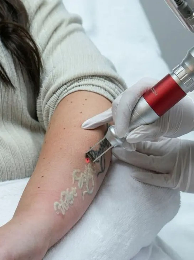 Tattoo Removal Jaipur